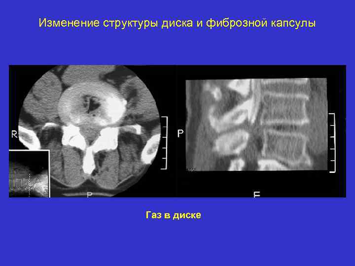 Изменение структуры диска и фиброзной капсулы Газ в диске 