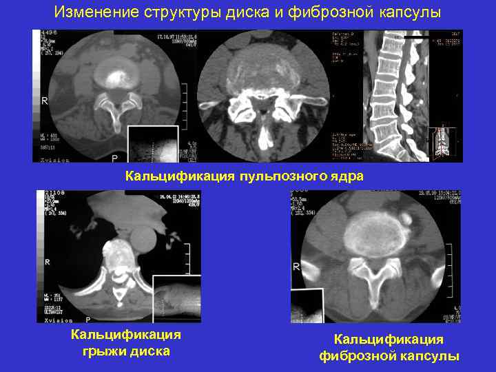 Изменение структуры диска и фиброзной капсулы Кальцификация пульпозного ядра Кальцификация грыжи диска Кальцификация фиброзной