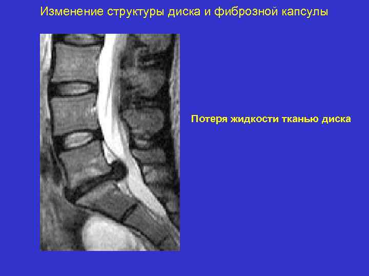 Изменение структуры диска и фиброзной капсулы Потеря жидкости тканью диска 