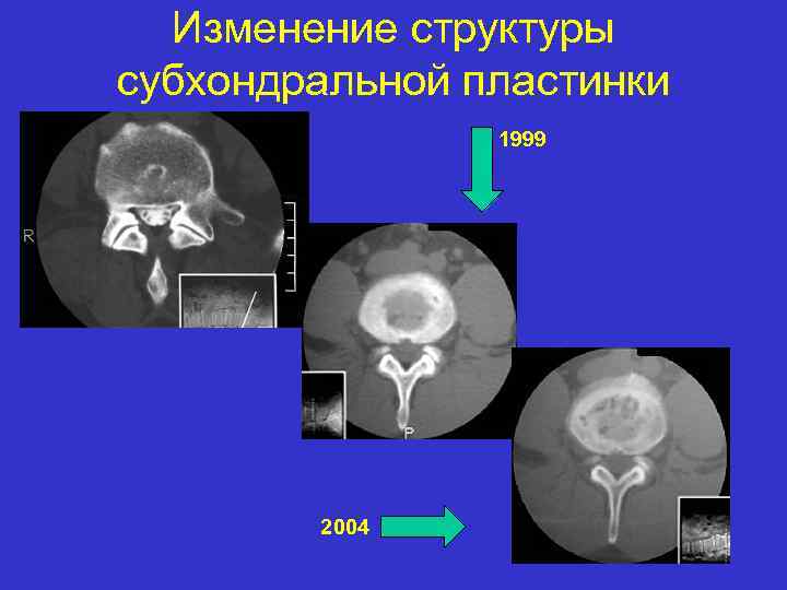 Изменение структуры субхондральной пластинки 1999 2004 
