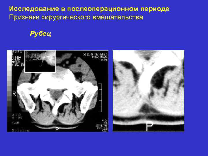 Исследование в послеоперационном периоде Признаки хирургического вмешательства Рубец 
