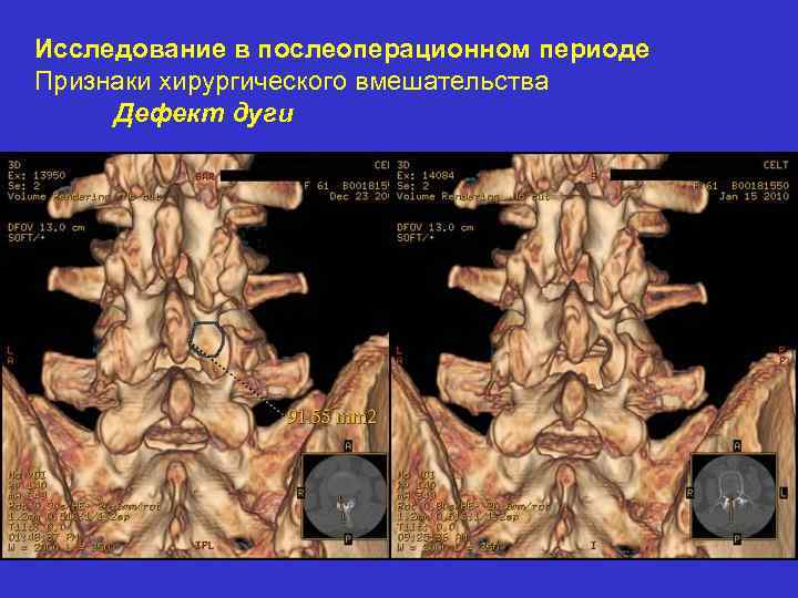 Исследование в послеоперационном периоде Признаки хирургического вмешательства Дефект дуги 