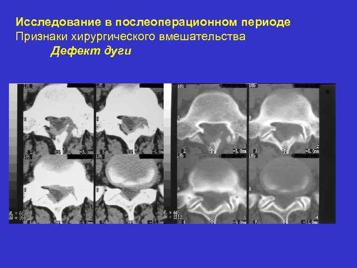 Исследование в послеоперационном периоде Признаки хирургического вмешательства Дефект дуги 