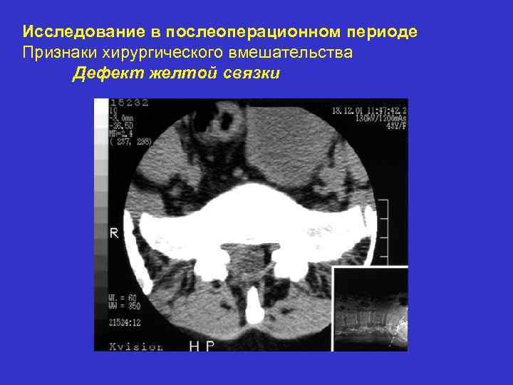 Исследование в послеоперационном периоде Признаки хирургического вмешательства Дефект желтой связки 