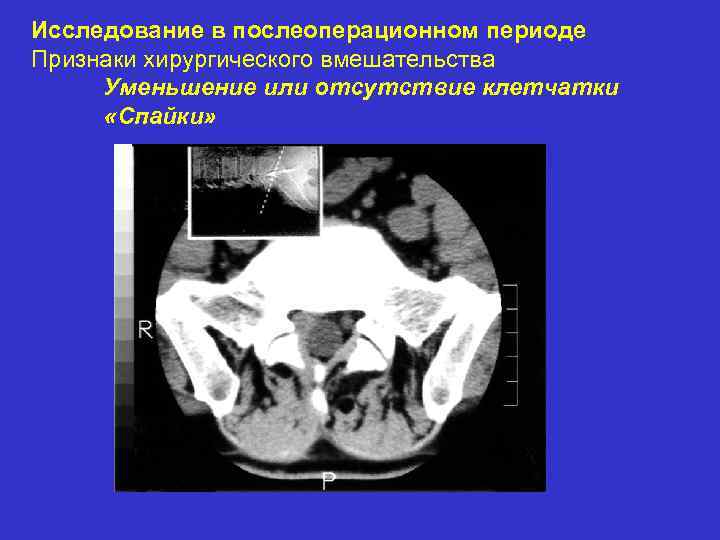 Исследование в послеоперационном периоде Признаки хирургического вмешательства Уменьшение или отсутствие клетчатки «Спайки» 