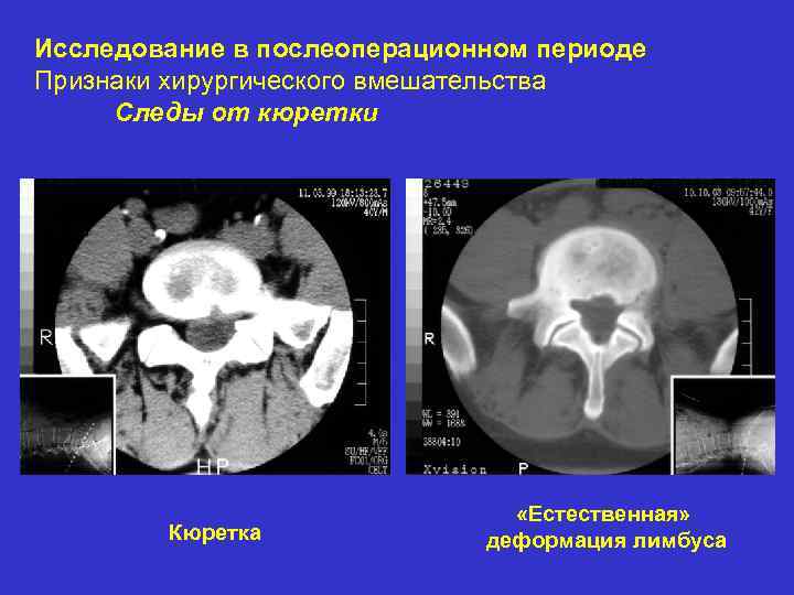 Исследование в послеоперационном периоде Признаки хирургического вмешательства Следы от кюретки Кюретка «Естественная» деформация лимбуса