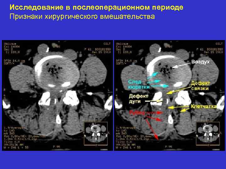 Исследование в послеоперационном периоде Признаки хирургического вмешательства 