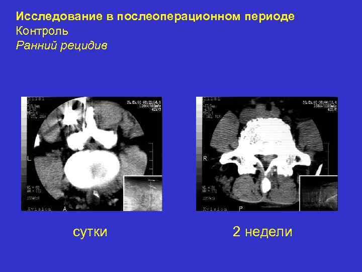 Исследование в послеоперационном периоде Контроль Ранний рецидив сутки 2 недели 