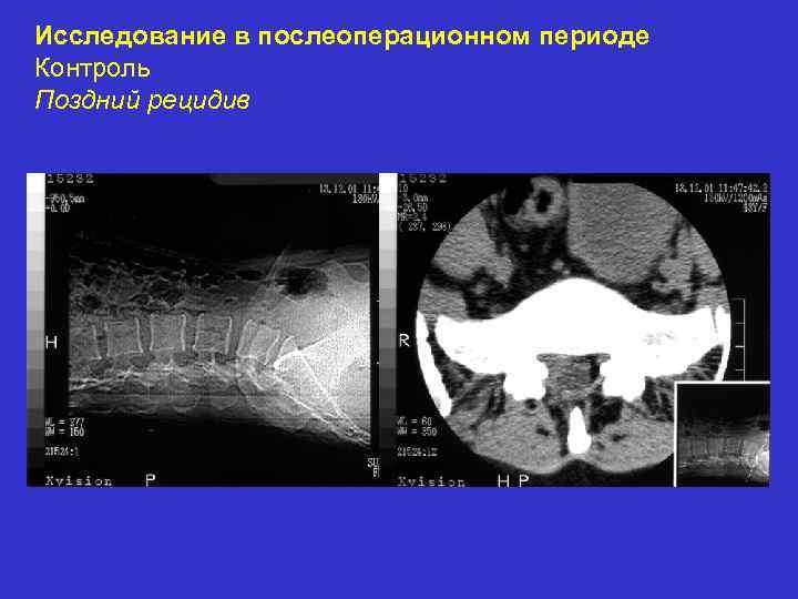 Исследование в послеоперационном периоде Контроль Поздний рецидив 