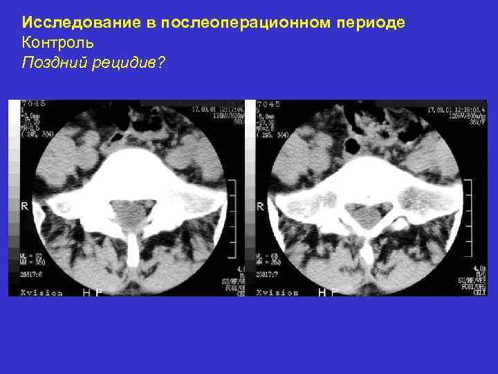 Исследование в послеоперационном периоде Контроль Поздний рецидив? 
