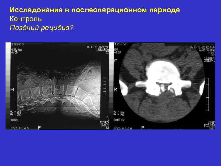 Исследование в послеоперационном периоде Контроль Поздний рецидив? 