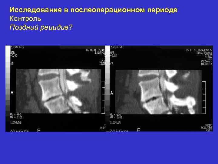 Исследование в послеоперационном периоде Контроль Поздний рецидив? 