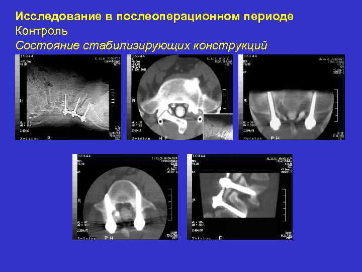 Исследование в послеоперационном периоде Контроль Состояние стабилизирующих конструкций 