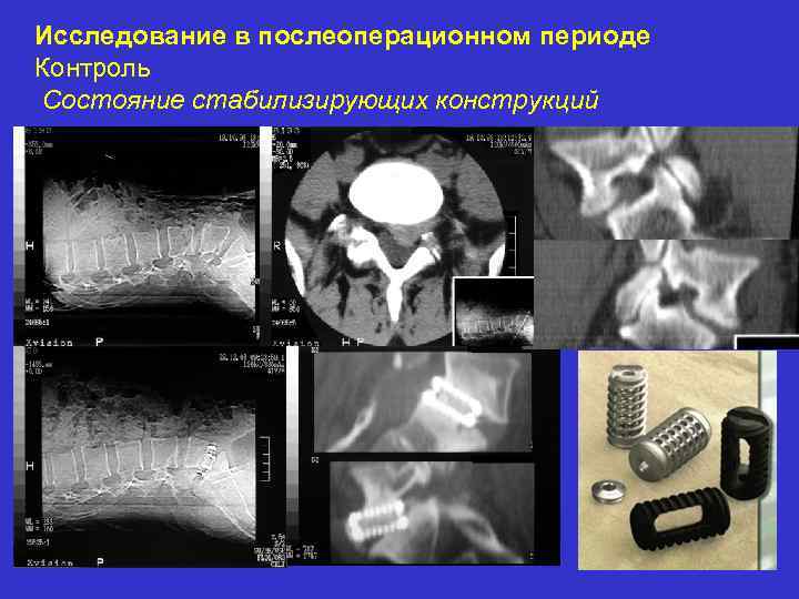 Исследование в послеоперационном периоде Контроль Состояние стабилизирующих конструкций 