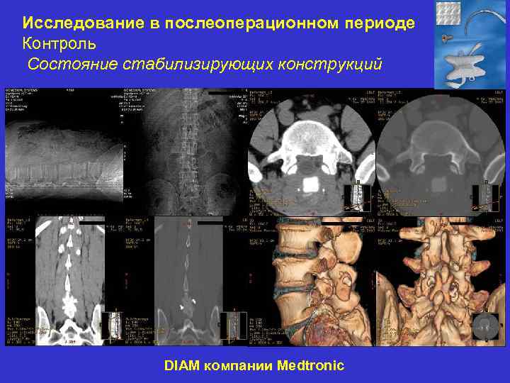 Исследование в послеоперационном периоде Контроль Состояние стабилизирующих конструкций DIAM компании Medtronic 
