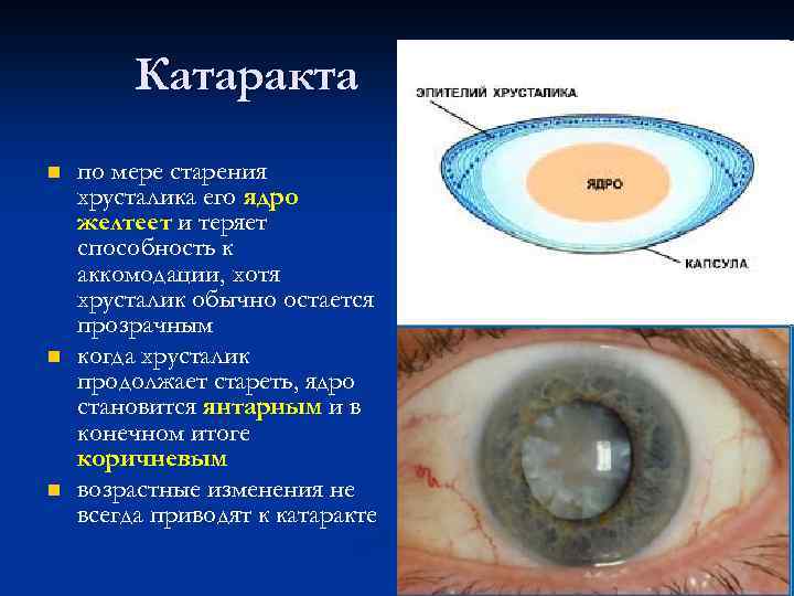 Катаракта n n n по мере старения хрусталика его ядро желтеет и теряет способность