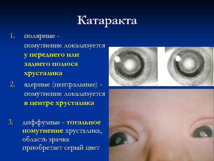 Катаракта 1. 2. 3. полярные помутнение локализуется у переднего или заднего полюса хрусталика ядерные