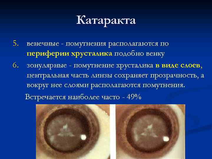 Катаракта 5. венечные - помутнения располагаются по периферии хрусталика подобно венку 6. зонулярные -