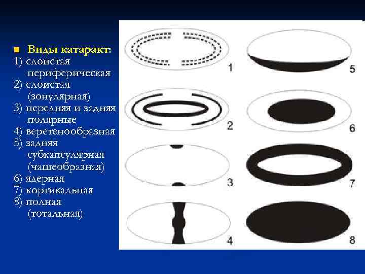 Виды катаракт: 1) слоистая периферическая 2) слоистая (зонулярная) 3) передняя и задняя полярные 4)