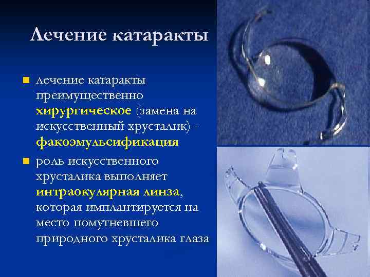 Лечение катаракты n n лечение катаракты преимущественно хирургическое (замена на искусственный хрусталик) факоэмульсификация роль