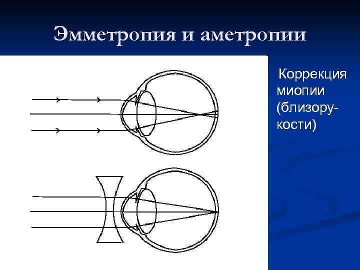 Миопия гиперметропия эмметропия