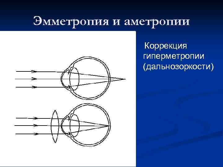 Эмметропия и аметропии Коррекция гиперметропии (дальнозоркости) 