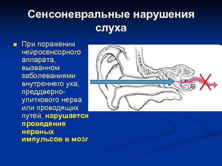 Сенсоневральная тугоухость картинки