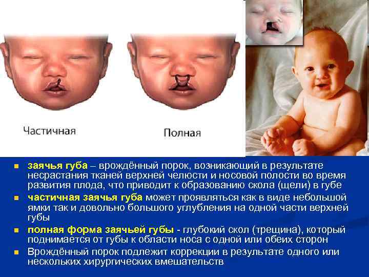 n n заячья губа – врождённый порок, возникающий в результате несрастания тканей верхней челюсти