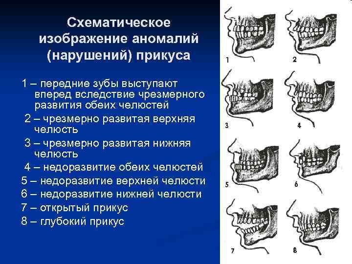 Схематическое изображение аномалий (нарушений) прикуса 1 – передние зубы выступают вперед вследствие чрезмерного развития