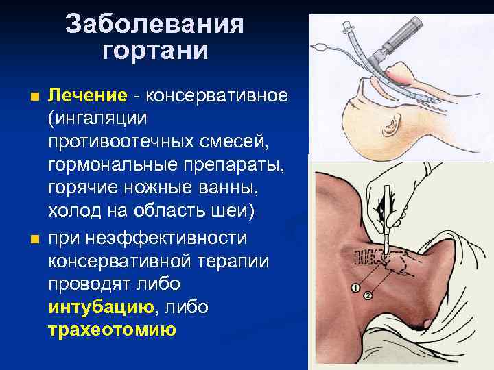 Заболевания гортани n n Лечение - консервативное (ингаляции противоотечных смесей, гормональные препараты, горячие ножные