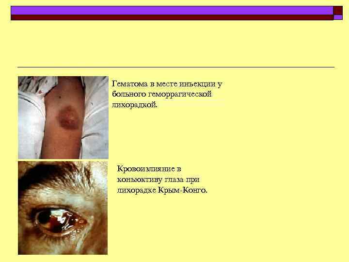 Гематома в месте инъекции у больного геморрагической лихорадкой. Кровоизлияние в коньюктиву глаза при лихорадке