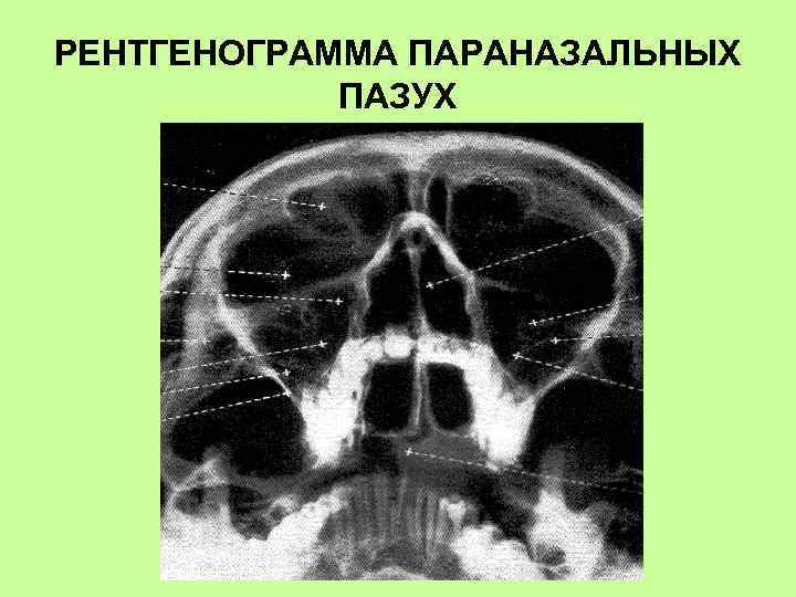 РЕНТГЕНОГРАММА ПАРАНАЗАЛЬНЫХ ПАЗУХ 