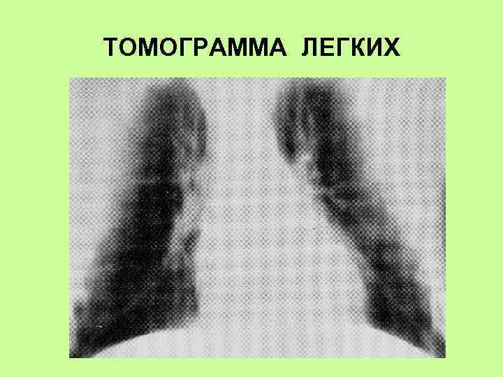 ТОМОГРАММА ЛЕГКИХ 