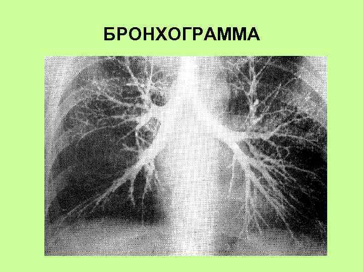 БРОНХОГРАММА 