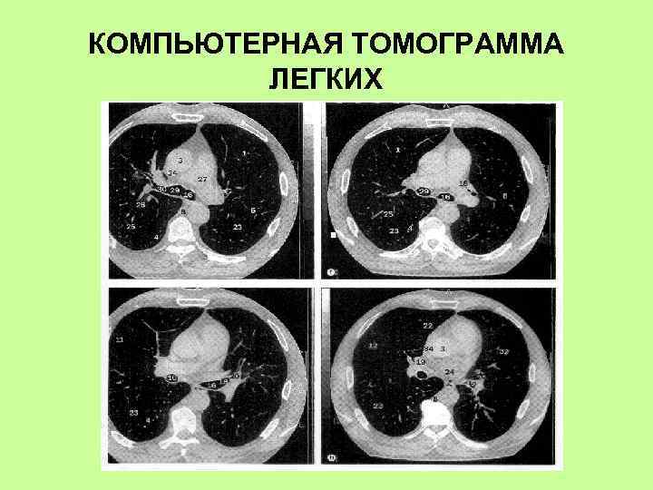 КОМПЬЮТЕРНАЯ ТОМОГРАММА ЛЕГКИХ 