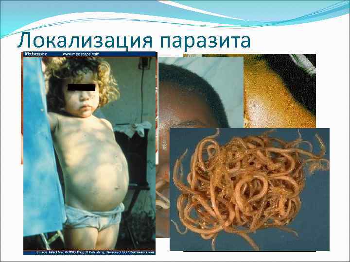 Локализация паразита 