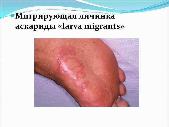  Мигрирующая личинка аскариды «larva migrants» 