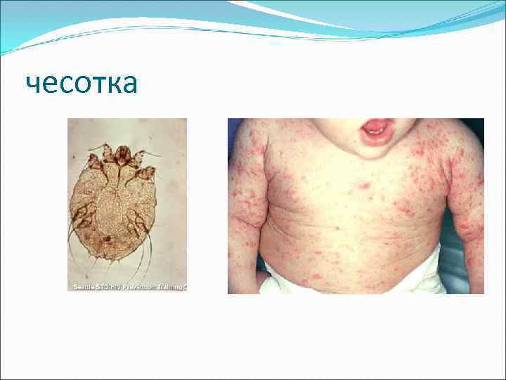 чесотка 