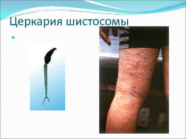 Церкария шистосомы 