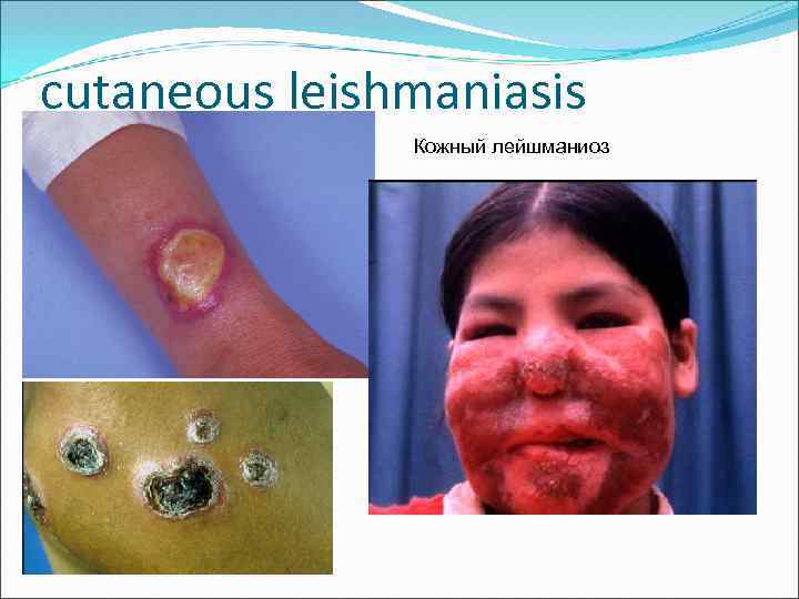 cutaneous leishmaniasis Кожный лейшманиоз 