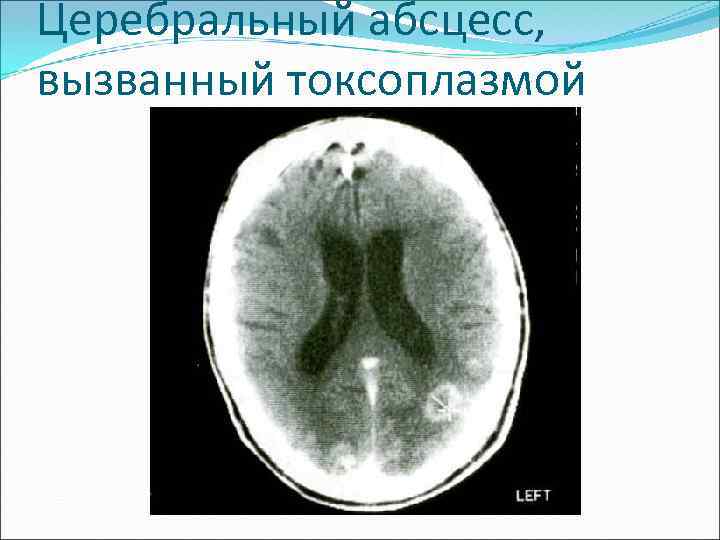 Церебральный абсцесс, вызванный токсоплазмой 