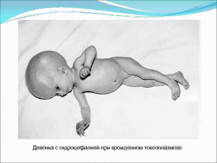 Девочка с гидроцефалией при врожденном токсоплазмозе 