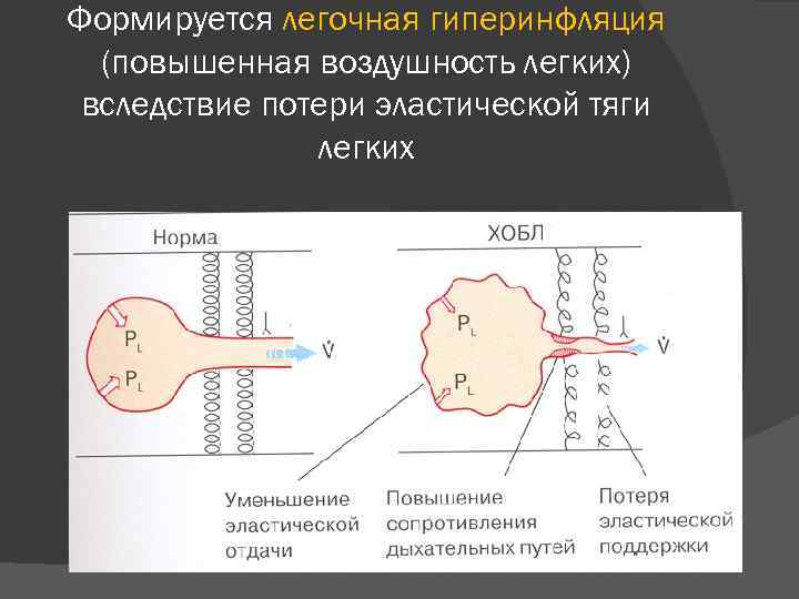 Формируется легочная гиперинфляция (повышенная воздушность легких) вследствие потери эластической тяги легких 