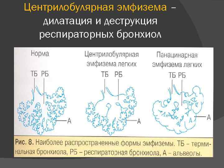 Центрилобулярная эмфизема – дилатация и деструкция респираторных бронхиол 