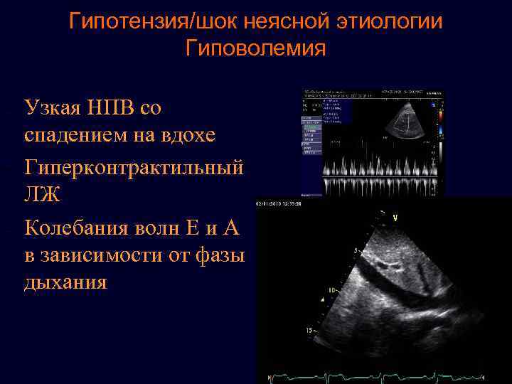 Гипотензия/шок неясной этиологии Гиповолемия - Узкая НПВ со спадeнием на вдохе - Гиперконтрактильный ЛЖ