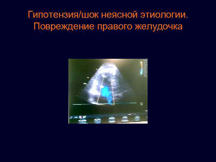 Гипотензия/шок неясной этиологии. Повреждение правого желудочка 