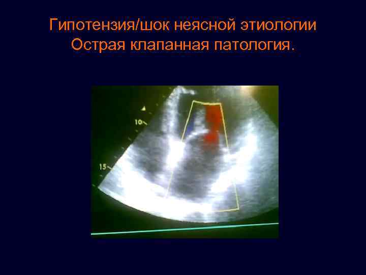 Гипотензия/шок неясной этиологии Острая клапанная патология. 