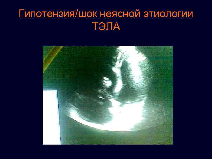 Гипотензия/шок неясной этиологии ТЭЛА 