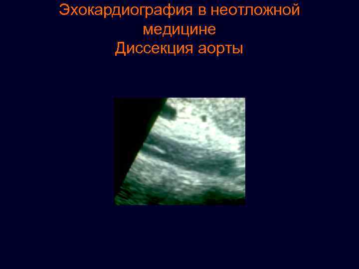 Эхокардиография в неотложной медицине Диссекция аорты 