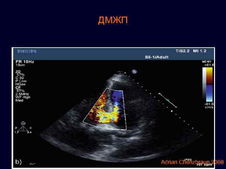 ДМЖП Adrian Chenzbraun, 2008 